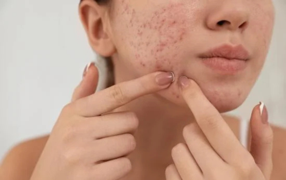 Acne & Pimple Control Solutions-skin care in bangalore-facial in hsr layout